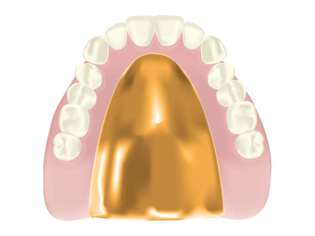 ゴールド床義歯
